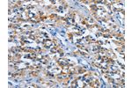The image on the left is immunohistochemistry of paraffin-embedded Human thyroid cancer tissue using CSB-PA808765(ETHE1 Antibody) at dilution 1/20, on the right is treated with fusion protein. (Original magnification: 