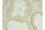 Immunohistochemistry of paraffin-embedded human prostate cancer using CSB-PA809014LA01HU at dilution of 1:100