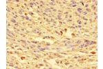 Immunohistochemistry of paraffin-embedded human melanoma cancer using CSB-PA809015LA01HU at dilution of 1:100