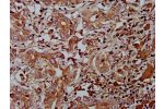 IHC image of CSB-PA812872LA01HU diluted at 1:400 and staining in paraffin-embedded human liver cancer performed on a Leica BondTM system. After dewaxing and hydration, antigen retrieval was mediated by high pressure in a citrate buffer (pH 6.0). Section w