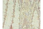 Immunohistochemistry of paraffin-embedded human colon cancer using CSB-PA812898LA01HU at dilution 1:100