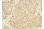 Immunohistochemistry of paraffin-embedded human gastric cancer using CSB-PA814224LA01HU at dilution of 1:100