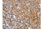 The image on the left is immunohistochemistry of paraffin-embedded Human thyroid cancer tissue using CSB-PA815431(CEACAM1 Antibody) at dilution 1/25, on the right is treated with synthetic peptide. (Original magnification: 