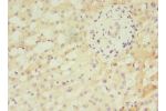 Immunohistochemistry of paraffin-embedded human liver cancer using CSB-PA815551LA01HU at dilution of 1:100