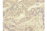 Immunohistochemistry of paraffin-embedded human colon cancer using CSB-PA815554LA01HU at dilution of 1:100