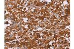The image on the left is immunohistochemistry of paraffin-embedded Human thyroid cancer tissue using CSB-PA815855(DCBLD2 Antibody) at dilution 1/50, on the right is treated with fusion protein. (Original magnification: 
