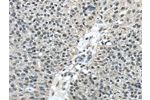 The image on the left is immunohistochemistry of paraffin-embedded Human breast cancer tissue using CSB-PA815873(FUS Antibody) at dilution 1/40, on the right is treated with fusion protein. (Original magnification: 