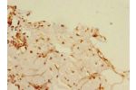 Immunohistochemistry of paraffin-embedded human breast cancer using CSB-PA818276ESR2HU at dilution 1:100