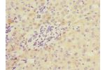 Immunohistochemistry of paraffin-embedded human liver cancer using CSB-PA818712ESR2HU at dilution 1:100