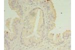 Immunohistochemistry of paraffin-embedded human prostate cancer using CSB-PA819448LA01HU at dilution of 1:100