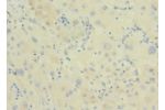 Immunohistochemistry of paraffin-embedded human liver cancer CSB-PA819454LA01HU at dilution 1:100