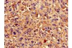 Immunohistochemistry of paraffin-embedded human melanoma cancer using CSB-PA819904LA01HU at dilution of 1:100