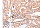 The image on the left is immunohistochemistry of paraffin-embedded Human thyroid cancer tissue using CSB-PA821404(DAZ4 Antibody) at dilution 1/50, on the right is treated with fusion protein. (Original magnification: 