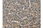 The image on the left is immunohistochemistry of paraffin-embedded Human liver cancer tissue using CSB-PA821534(ENO1 Antibody) at dilution 1/60, on the right is treated with fusion protein. (Original magnification: 
