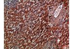 Immunohistochemical analysis of paraffin-embedded Human-liver-cancer, antibody was diluted at 1:100