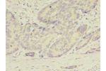 Immunohistochemistry of paraffin-embedded human gastric cancer using CSB-PA822186LA01HU at dilution of 1:100