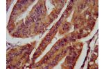 IHC image of CSB-PA822228LA01HU diluted at 1:800 and staining in paraffin-embedded human endometrial cancer performed on a Leica BondTM system. After dewaxing and hydration, antigen retrieval was mediated by high pressure in a citrate buffer (pH 6.0). Sec