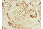 Immunohistochemistry of paraffin-embedded human breast cancer using CSB-PA822259ESR2HU at dilution 1:100