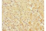 Immunohistochemistry of paraffin-embedded human liver cancer using CSB-PA822270ESR2HU at dilution 1:100