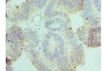 Immunohistochemistry of paraffin-embedded human colon cancer using CSB-PA822303ESR2HU at dilution 1:100