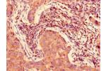Immunohistochemistry of paraffin-embedded human pancreatic cancer using CSB-PA822711LA01HU at dilution of 1:100