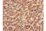 Immunohistochemistry of paraffin-embedded human liver cancer using CSB-PA823443LA01HU at dilution of 1:100