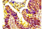 IHC image of CSB-PA823469LA01HU diluted at 1:500 and staining in paraffin-embedded human ovarian cancer performed on a Leica BondTM system. After dewaxing and hydration, antigen retrieval was mediated by high pressure in a citrate buffer (pH 6.0). Section
