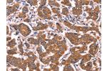 The image on the left is immunohistochemistry of paraffin-embedded Human breast cancer tissue using CSB-PA824118(COL20A1 Antibody) at dilution 1/40, on the right is treated with fusion protein. (Original magnification: 