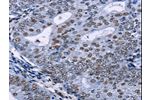 The image on the left is immunohistochemistry of paraffin-embedded Human cervical cancer tissue using CSB-PA824713(CREBBP Antibody) at dilution 1/5, on the right is treated with synthetic peptide. (Original magnification: 
