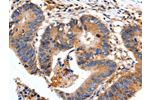 The image on the left is immunohistochemistry of paraffin-embedded Human colon cancer tissue using CSB-PA824751(FADD Antibody) at dilution 1/35, on the right is treated with fusion protein. (Original magnification: 