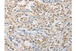 The image on the left is immunohistochemistry of paraffin-embedded Human thyroid cancer tissue using CSB-PA825036(APLF Antibody) at dilution 1/40, on the right is treated with fusion protein. (Original magnification: 
