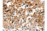 The image on the left is immunohistochemistry of paraffin-embedded Human lung cancer tissue using CSB-PA825136(CTSB Antibody) at dilution 1/35, on the right is treated with fusion protein. (Original magnification: 