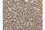 The image on the left is immunohistochemistry of paraffin-embedded Human prostate cancer tissue using CSB-PA825632(FBP1 Antibody) at dilution 1/40, on the right is treated with fusion protein. (Original magnification: 
