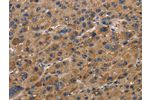 The image on the left is immunohistochemistry of paraffin-embedded Human liver cancer tissue using CSB-PA826268(FABP2 Antibody) at dilution 1/40, on the right is treated with synthetic peptide. (Original magnification: 