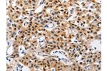 The image on the left is immunohistochemistry of paraffin-embedded Human lung cancer tissue using CSB-PA826461(GCG(GLP1) Antibody) at dilution 1/30, on the right is treated with synthetic peptide. (Original magnification: 