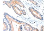 The image on the left is immunohistochemistry of paraffin-embedded Human colon cancer tissue using CSB-PA826742(ACOX2 Antibody) at dilution 1/25, on the right is treated with fusion protein. (Original magnification: 