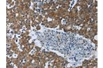 The image on the left is immunohistochemistry of paraffin-embedded Human breast cancer tissue using CSB-PA826977(EIF2AK2 Antibody) at dilution 1/60, on the right is treated with synthetic peptide. (Original magnification: 