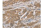 The image on the left is immunohistochemistry of paraffin-embedded Human ovarian cancer tissue using CSB-PA827150(CST6 Antibody) at dilution 1/30, on the right is treated with fusion protein. (Original magnification: 