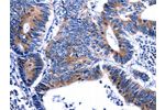 The image on the left is immunohistochemistry of paraffin-embedded Human colon cancer tissue using CSB-PA827246(GIP Antibody) at dilution 1/13, on the right is treated with fusion protein. (Original magnification: 