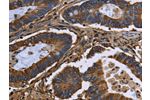 The image on the left is immunohistochemistry of paraffin-embedded Human colon cancer tissue using CSB-PA827609(FGB Antibody) at dilution 1/20, on the right is treated with fusion protein. (Original magnification: 