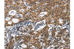 The image on the left is immunohistochemistry of paraffin-embedded Human gastic cancer tissue using CSB-PA827634(DCC Antibody) at dilution 1/70, on the right is treated with synthetic peptide. (Original magnification: 
