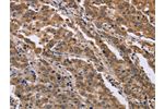 The image on the left is immunohistochemistry of paraffin-embedded Human liver cancer tissue using CSB-PA828051(FAM3B Antibody) at dilution 1/40, on the right is treated with fusion protein. (Original magnification: 