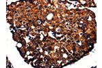 The image is immunohistochemistry of paraffin-embedded Human breast cancer tissue using CSB-PA828204(APLP1 Antibody) at dilution 1/10. (Original magnification: 