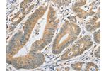 The image on the left is immunohistochemistry of paraffin-embedded Human colon cancer tissue using CSB-PA828297(ATG10 Antibody) at dilution 1/60, on the right is treated with fusion protein. (Original magnification: 