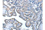 The image on the left is immunohistochemistry of paraffin-embedded Human thyroid cancer tissue using CSB-PA828335(AMDHD2 Antibody) at dilution 1/40, on the right is treated with fusion protein. (Original magnification: 