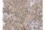 The image on the left is immunohistochemistry of paraffin-embedded Human breast cancer tissue using CSB-PA828857(ACTN2 Antibody) at dilution 1/30, on the right is treated with synthetic peptide. (Original magnification: 