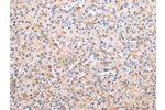 The image on the left is immunohistochemistry of paraffin-embedded Human liver cancer tissue using CSB-PA828936(AXIN1  Antibody) at dilution 1/30, on the right is treated with synthetic peptide. (Original magnification: 