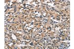 The image on the left is immunohistochemistry of paraffin-embedded Human thyroid cancer tissue using CSB-PA829218(ACPT Antibody) at dilution 1/30, on the right is treated with synthetic peptide. (Original magnification: 