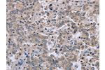 The image on the left is immunohistochemistry of paraffin-embedded Human liver cancer tissue using CSB-PA829370(EID1 Antibody) at dilution 1/40, on the right is treated with fusion protein. (Original magnification: 