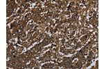 The image on the left is immunohistochemistry of paraffin-embedded Human liver cancer tissue using CSB-PA829442(GLO1 Antibody) at dilution 1/60, on the right is treated with fusion protein. (Original magnification: 